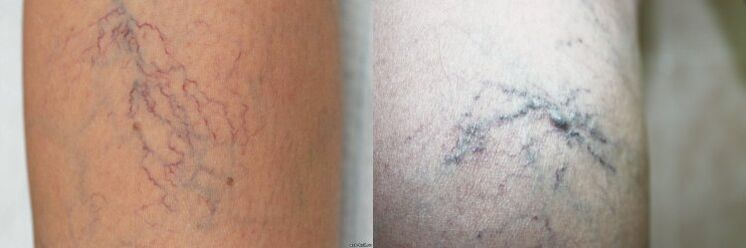 Varicose symptoms