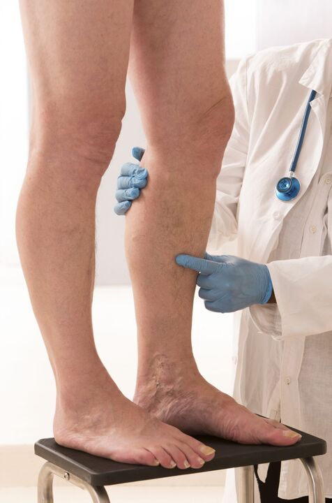 Varicosis what is it