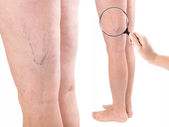 Varices in women