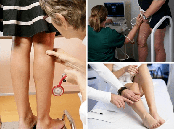 Varices on the legs