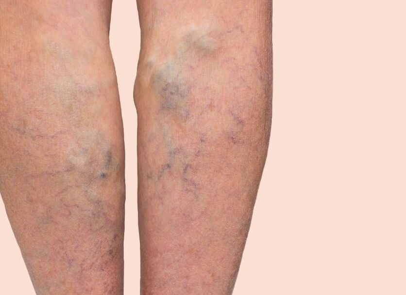 What the varicose veins look like