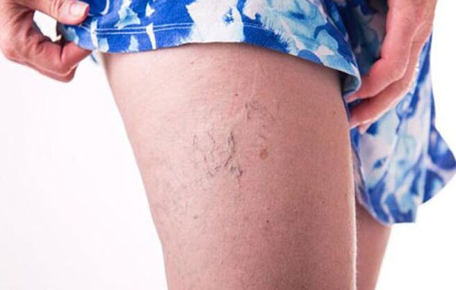 Varices on the leg