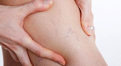 Varicious signs and symptoms
