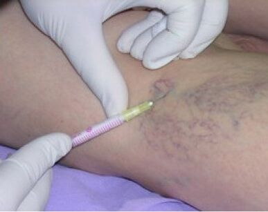 injections for varicose veins