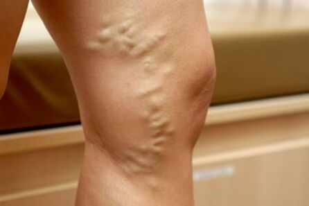 medicines for varicose veins