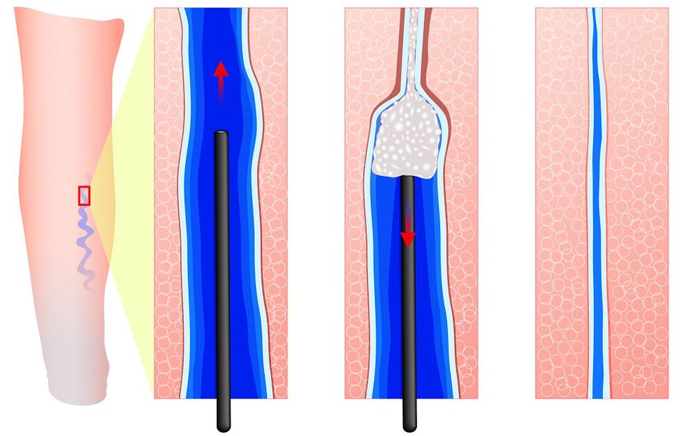 Sclerotherapy mechanism