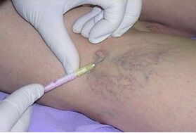 Sclerotherapy is a method of treating varicose veins in the legs