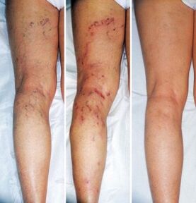 The result of treatment for varicose veins of the lower limbs