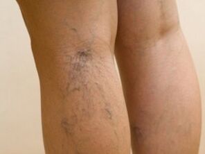 Veins protruding under the skin are a symptom of varicose veins on the legs