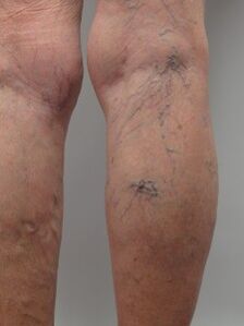 With varicose veins of the lower extremities, tortuous veins protrude above the surface of the skin