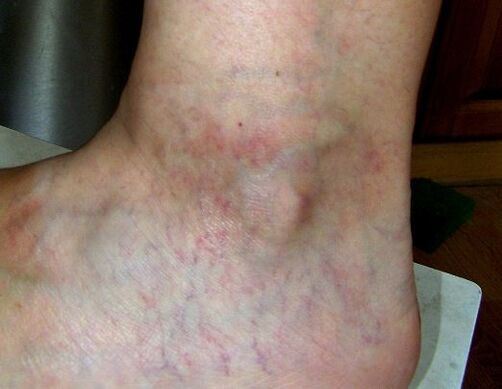 Manifestations of varicose veins of the lower limbs