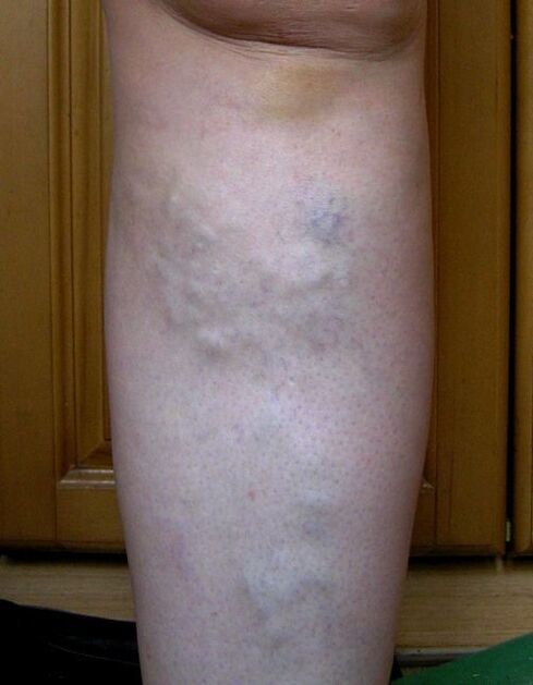 Swollen veins on the leg due to varicose veins